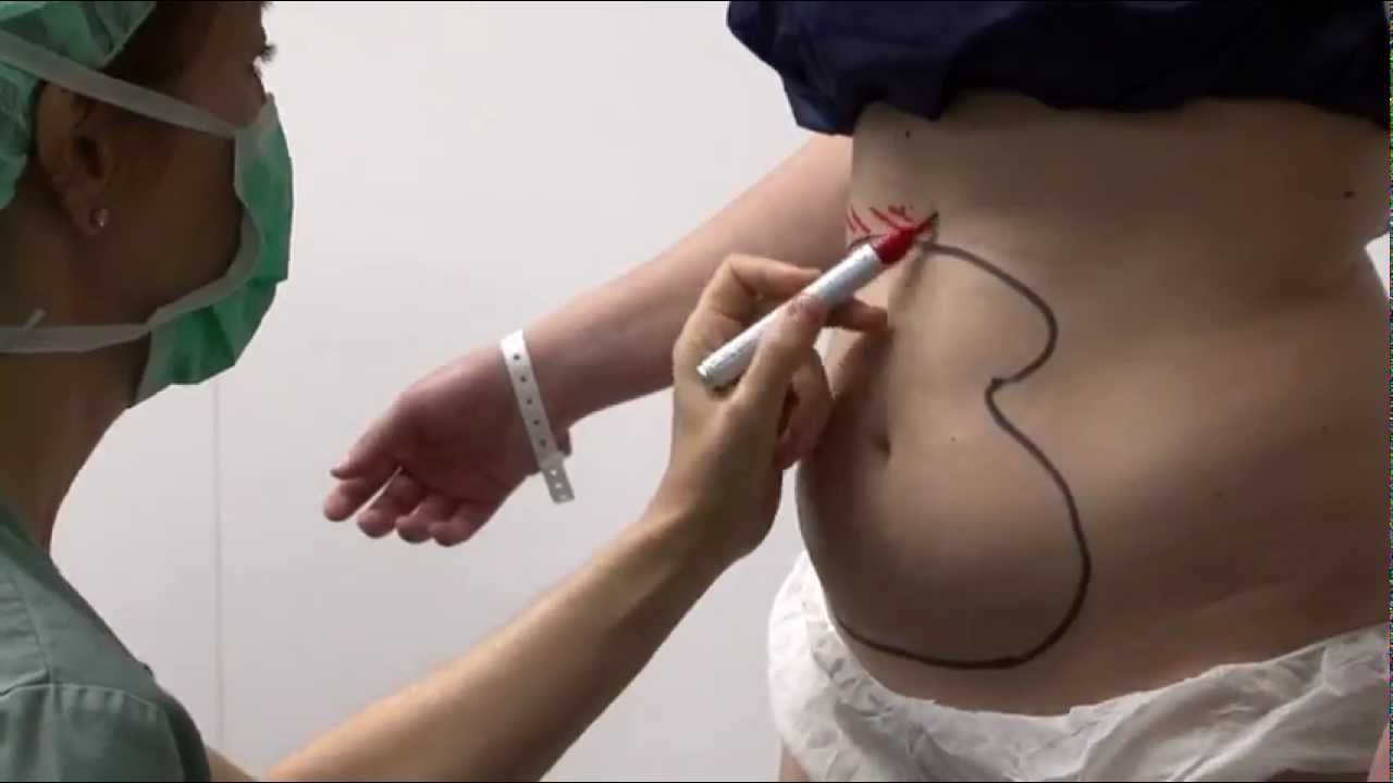 En este momento estás viendo Lipofilling, la técnica más revolucionaria de cirugía estética